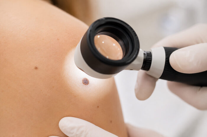 Dra Erika Debs - Dermatologista em Atibaia - Checagem de Nevos por Dermatoscopia