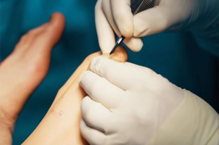 Dra Erika Debs - Dermatologista em Atibaia - Cirurgia de Unha Encravada Dra Erika Debs - Dermatologista em Atibaia - Cirurgia de Unha Encravada