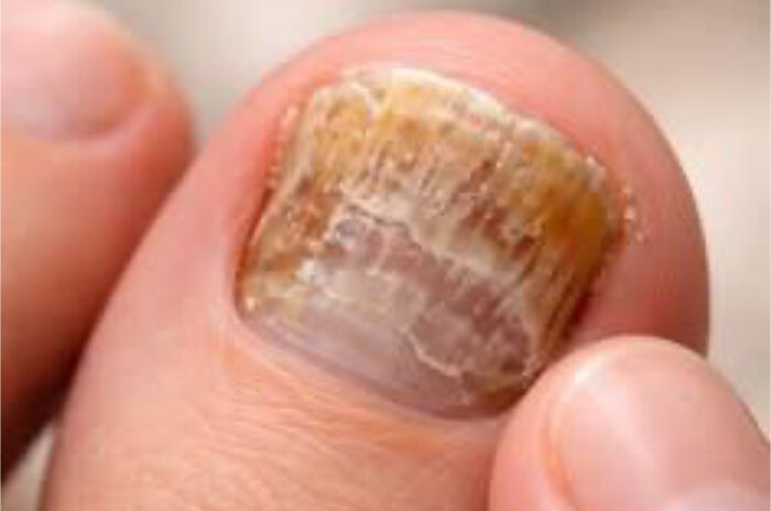 Dra Erika Debs - Dermatologista em Atibaia - Doenças das Unhas