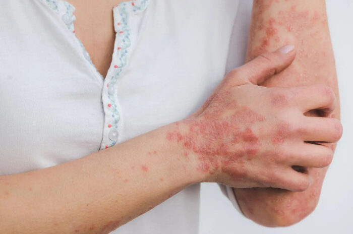 Dra Erika Debs - Dermatologista em Atibaia - Micose Dra Erika Debs - Dermatologista em Atibaia - Micose