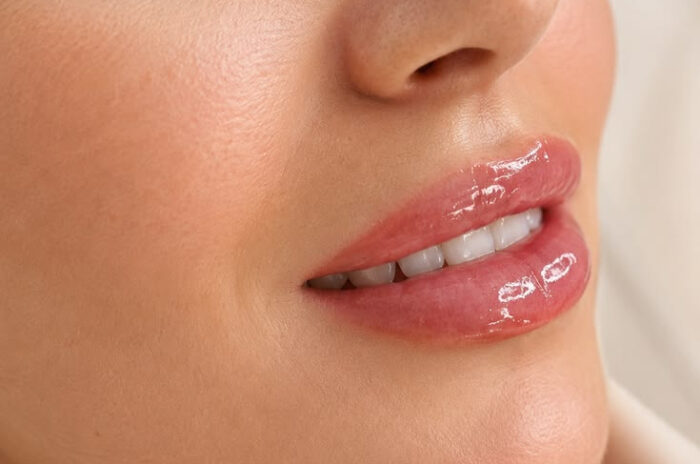 Dra Erika Debs - Dermatologista em Atibaia - Preenchimento Labial Dra Erika Debs - Dermatologista em Atibaia - Preenchimento Labial
