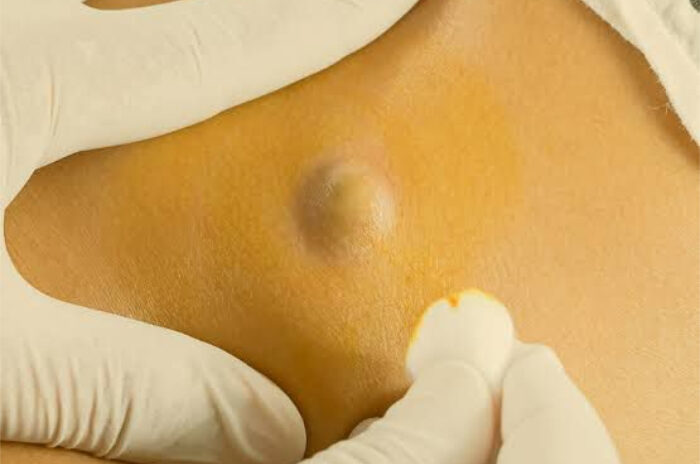 Dra Erika Debs - Dermatologista em Atibaia - Retirada de Cistos e Lipomas Dra Erika Debs - Dermatologista em Atibaia - Retirada de Cistos e Lipomas
