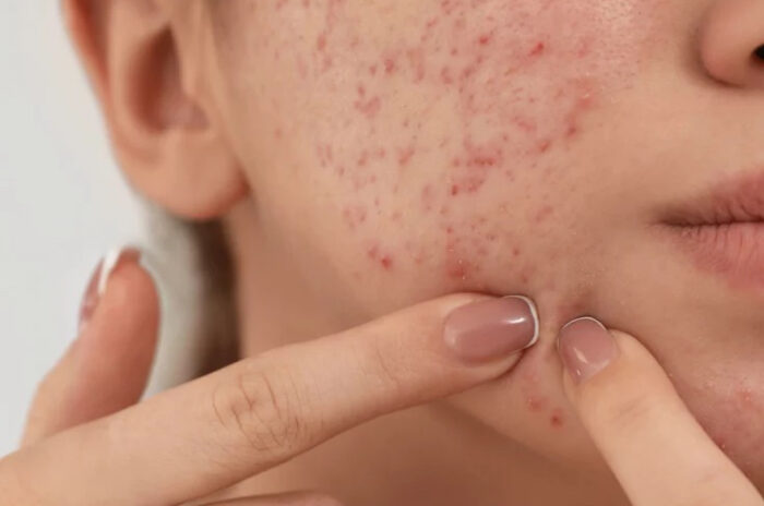 Dra Erika Debs - Dermatologista em Atibaia - Tratamento de Acne