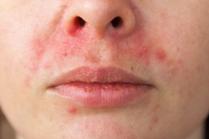 Dra Erika Debs - Dermatologista em Atibaia - Tratamento de Dermatite Perioral