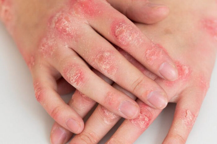 Dra Erika Debs - Dermatologista em Atibaia - Tratamento de Eczemas Dra Erika Debs - Dermatologista em Atibaia - Tratamento de Eczemas