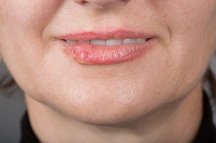 Dra Erika Debs - Dermatologista em Atibaia - Tratamento de Herpes Dra Erika Debs - Dermatologista em Atibaia - Tratamento de Herpes