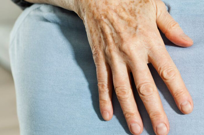 Dra Erika Debs - Dermatologista em Atibaia - Tratamento de Melanose de Mãos e Face