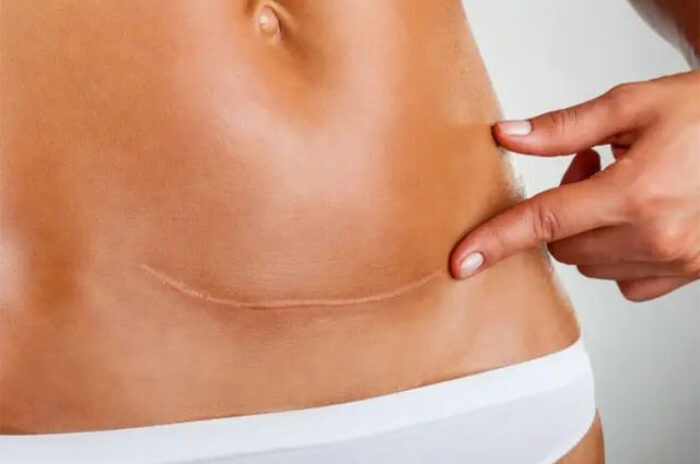 Dra Erika Debs - Dermatologista em Atibaia - Tratamento de Queloides e Cicatrizes Dra Erika Debs - Dermatologista em Atibaia - Tratamento de Queloides e Cicatrizes