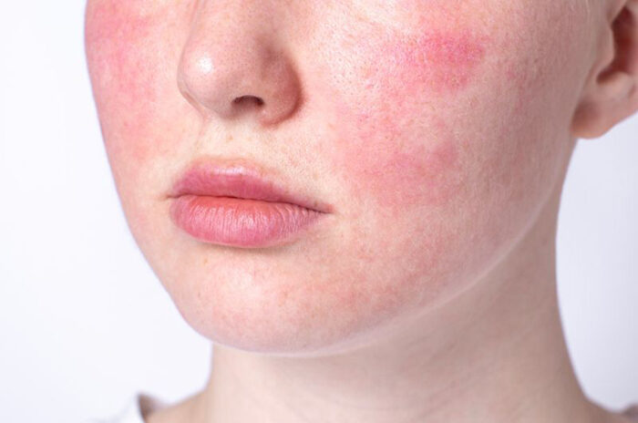 Dra Erika Debs - Dermatologista em Atibaia - Tratamento de Rosácea