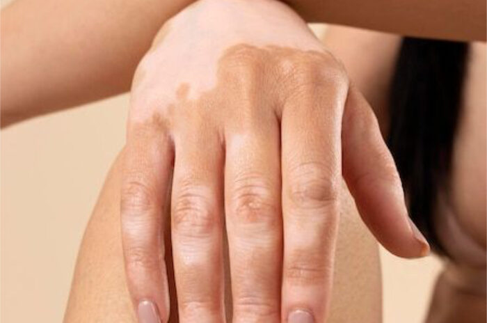 Dra Erika Debs - Dermatologista em Atibaia - Tratamento de Vitiligo Dra Erika Debs - Dermatologista em Atibaia - Tratamento de Vitiligo