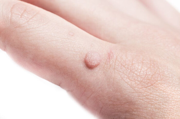 Dra Erika Debs - Dermatologista em Atibaia - Verruga Dra Erika Debs - Dermatologista em Atibaia - Verruga